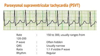1 CARDIAC DYSARHYTHMIAS - INTERPRETATION.pptx