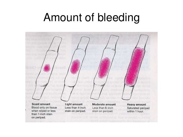 Image Result For Heavy Period After Tubal Ligation Image Result For Heavy Period After Tubal Ligation