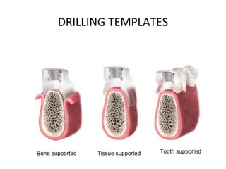 DRILLING TEMPLATES
Bone supported Tissue supported Tooth supported
 