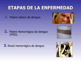 ETAPAS DE LA ENFERMEDAD 1 .   Fiebre clásica de dengue. 2.   Fiebre Hemorrágica de dengue (FHD). 3.   Shock hemorrágico de dengue. 