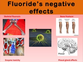 Fluoride’s negative
effects
Fluoride’s negative
effects
Skeletal fluorosis Bone fracture
Cancer
Enzyme toxicity Pineal gland effects
Skeletal fluorosis Bone fracture
Cancer
Enzyme toxicity Pineal gland effects
 