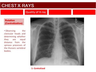 1 Chest X rays.pptx