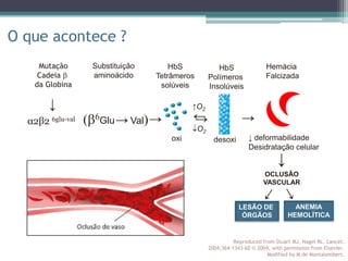 O que acontece ?
Reproduced from Stuart MJ, Nagel RL. Lancet.
2004;364:1343-60 © 2004, with permission from Elsevier.
Modified by M de Montalembert.
↓
HbS
Tetrâmeros
solúveis
oxi ↓ deformabilidade
Desidratação celular
Hemácia
Falcizada
↓
↓
OCLUSÃO
VASCULAR
LESÃO
TECIDUAL
↓
HbS
Polímeros
Insolúveis
desoxi
O2
Substituição
aminoácido
↓
(6Glu↓ Val)
Mutação
Cadeia 
da Globina
α2β2 6glu-val
DESTRUIÇÃO
ERITROCITÁRIA
↑O2
↓
LESÃO DE
ÓRGÃOS
ANEMIA
HEMOLÍTICA
 