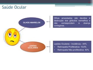 20
OLHOS AMARELOS
LESÕES
OCULARES
Saúde Ocular
Lesões Oculares - Incidência - 44%
• Retinopatia Proliferativa: 15,6%
• Retinopatia Não-proliferativa: 40%
Olhos amarelados são devidos à
destruição dos glóbulos vermelhos e
não correspondem à doença
contagiosa.
 