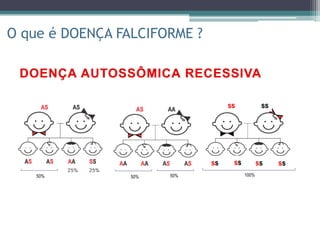 O que é DOENÇA FALCIFORME ?
50% 50%50% 100%
ss ss
ss ss ss ss
 
