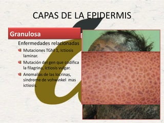 CAPAS DE LA EPIDERMIS
Enfermedades relacionadas
Mutaciones TGM 1, Ictiosis
laminar.
Mutación del gen que codifica
la filagrina, Ictiosis vulgar.
Anomalías de las locrinas,
síndrome de vohwinkel mas
ictiosis.
Granulosa
 