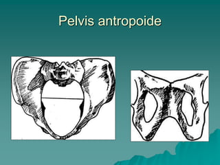 Pelvis antropoide
 