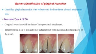 1 classification of periodontal disease.pdf