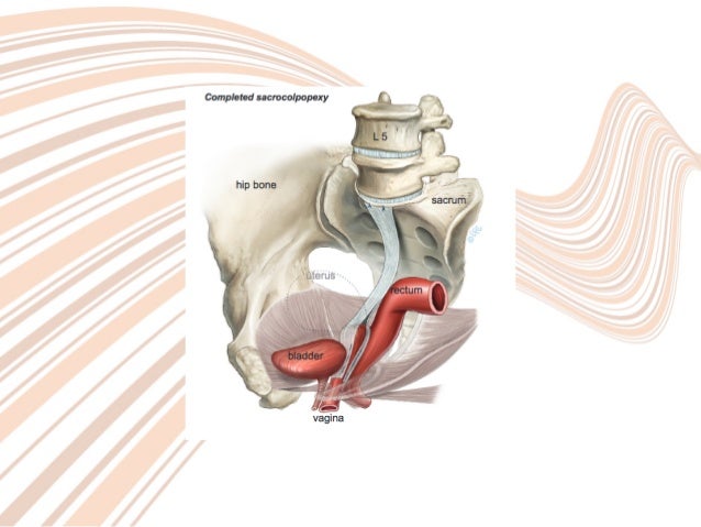 Colposacropexia Sociedad Venezolana de Cirugía