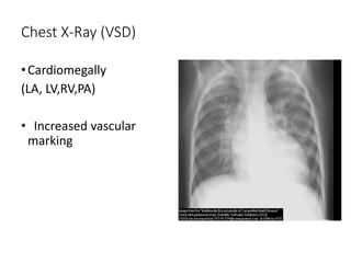 Chest X-Ray (VSD)
•Cardiomegally
(LA, LV,RV,PA)
• Increased vascular
marking
 