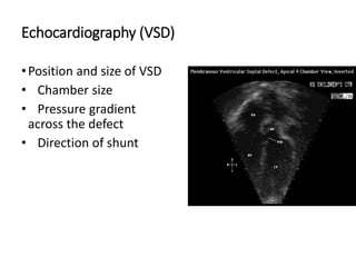 Echocardiography (VSD)
•Position and size of VSD
• Chamber size
• Pressure gradient
across the defect
• Direction of shunt
 