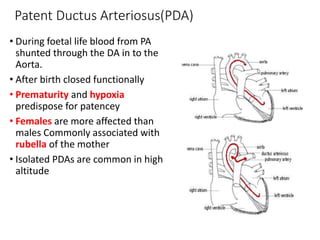 Patent Ductus Arteriosus(PDA)
• During foetal life blood from PA
shunted through the DA in to the
Aorta.
• After birth closed functionally
• Prematurity and hypoxia
predispose for patencey
• Females are more affected than
males Commonly associated with
rubella of the mother
• Isolated PDAs are common in high
altitude
 