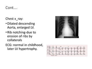 Cont….
Chest x_ray:
•Dilated descending
Aorta, enlarged LV.
•Rib notching-due to
erosion of ribs by
collaterals
ECG: normal in childhood,
later LV hypertrophy.
 