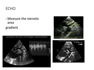 ECHO
: Measure the stenotic
area
gradient
 