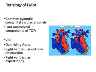 Tetralogy of Fallot
•Common cyanotic
congenital cardiac anomaly
•Four anatomical
components of TOF:
•VSD
•Overriding Aorta
•Right ventricular outflow
obstruction
•Right ventricular
hypertrophy
 