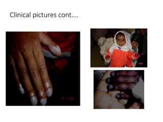 Clinical pictures cont….
 