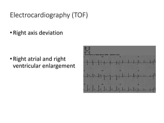 Electrocardiography (TOF)
•Right axis deviation
•Right atrial and right
ventricular enlargement
 
