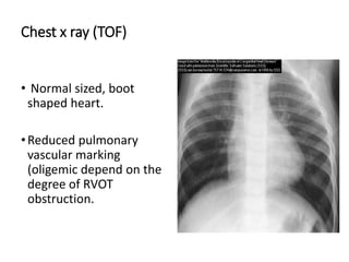 Chest x ray (TOF)
• Normal sized, boot
shaped heart.
•Reduced pulmonary
vascular marking
(oligemic depend on the
degree of RVOT
obstruction.
 