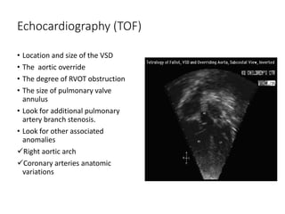 Echocardiography (TOF)
• Location and size of the VSD
• The aortic override
• The degree of RVOT obstruction
• The size of pulmonary valve
annulus
• Look for additional pulmonary
artery branch stenosis.
• Look for other associated
anomalies
Right aortic arch
Coronary arteries anatomic
variations
 