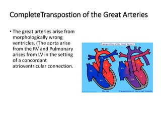 CompleteTranspostion of the Great Arteries
• The great arteries arise from
morphologically wrong
ventricles. (The aorta arise
from the RV and Pulmonary
arises from LV in the setting
of a concordant
atrioventricular connection.
 