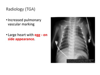 Radiology (TGA)
•Increased pulmonary
vascular marking
•Large heart with egg - on
side appearance.
 