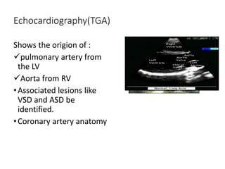 Echocardiography(TGA)
Shows the origion of :
pulmonary artery from
the LV
Aorta from RV
•Associated lesions like
VSD and ASD be
identified.
•Coronary artery anatomy
 