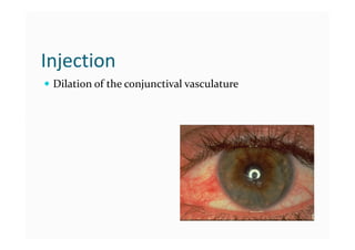 Conjunctive Injected 1 Conjunctiva.pdf