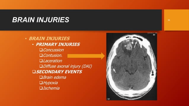 I LOVE NEUROSURGERY INITIATIVE Cranio cerebral Injuries Part 1 PPT i-love-neurosurgery-initiative-cranio-cerebral-injuries-part-1-ppt
