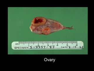 Ovary 
 