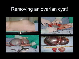 Removing an ovarian cyst! 
 