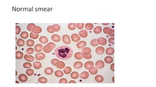 Normal smear
 