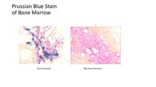 Prussian Blue Stain
of Bone Marrow
 