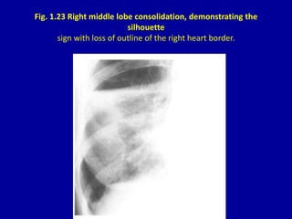 Fig. 1.23 Right middle lobe consolidation, demonstrating the
silhouette
sign with loss of outline of the right heart borde...