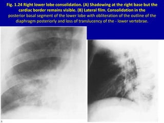 Fig. 1.24 Right lower lobe consolidation. (A) Shadowing at the right base but the
cardiac border remains visible. (B) Late...
