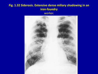Fig. 1.32 Siderosis. Extensive dense miliary shadowing in an
iron-foundry
worker.
 