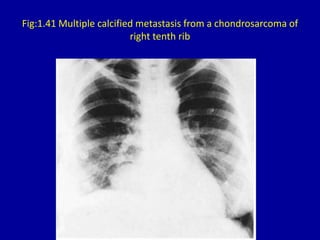 Fig:1.41 Multiple calcified metastasis from a chondrosarcoma of
right tenth rib
 