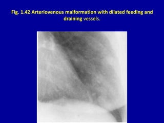 Fig. 1.42 Arteriovenous malformation with dilated feeding and
draining vessels.
 