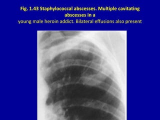 Fig. 1.43 Staphylococcal abscesses. Multiple cavitating
abscesses in a
young male heroin addict. Bilateral effusions also ...