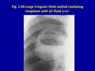 Fig. 1.44 Large irregular thick-walled cavitating
neoplasm with air-fluid level.
 