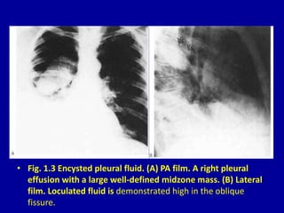 • Fig. 1.3 Encysted pleural fluid. (A) PA film. A right pleural
effusion with a large well-defined midzone mass. (B) Later...