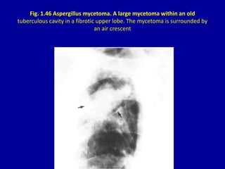 Fig. 1.46 Aspergillus mycetoma. A large mycetoma within an old
tuberculous cavity in a fibrotic upper lobe. The mycetoma i...
