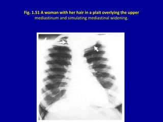 Fig. 1.51 A woman with her hair in a plait overlying the upper
mediastinum and simulating mediastinal widening.
 