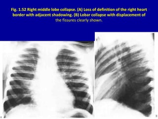 Fig. 1.52 Right middle lobe collapse. (A) Loss of definition of the right heart
border with adjacent shadowing. (B) Lobar ...