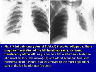• Fig. 1.5 Subpulmonary pleural fluid. (A) Erect PA radiograph. There
is apparent elevation of the left hemidiaphragm. Inc...
