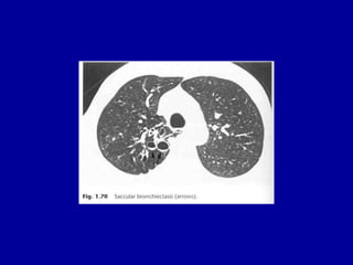 Fig. 1.76 HRCT lymphangitis carcinomatosa from carcinoma of the
breast. Note the thickened interlobular septa. (Courtesy o...