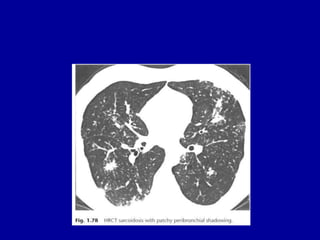 Fig. 1.93 Bullous emphysema. SPECT images showing multiple areas
of reduced perfusion particularly affecting lung apices, ...