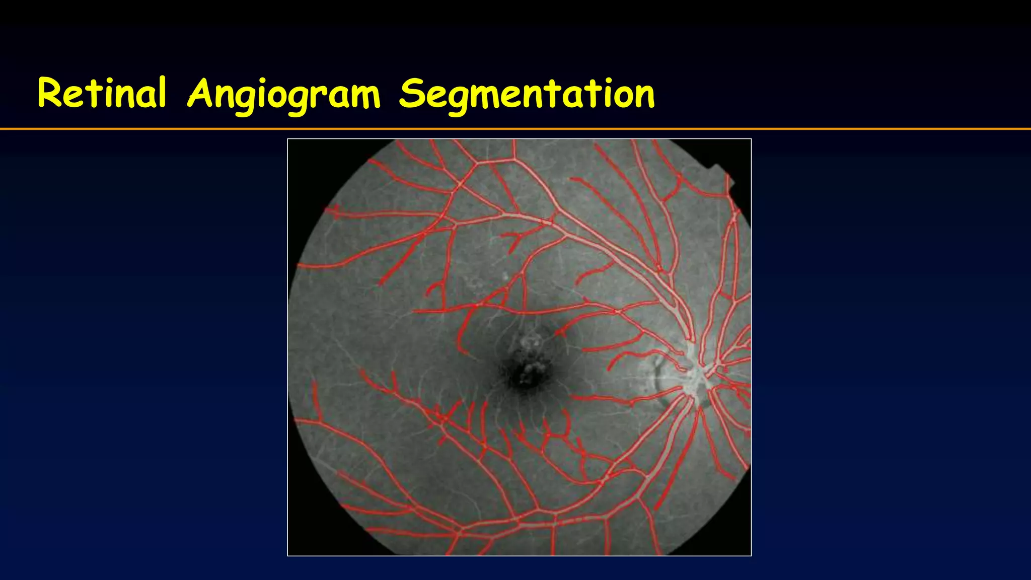 Retinal Angiogram Segmentation
 