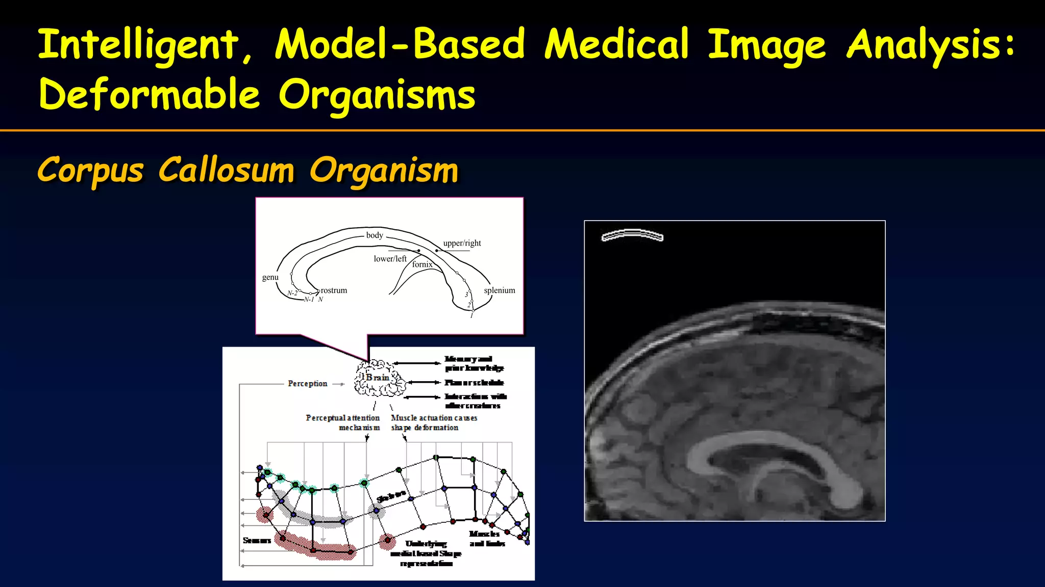 Intelligent, Model-Based Medical Image Analysis:
Deformable Organisms
Corpus Callosum Organism
fornix
2
3N-2
1
genu
spleniumrostrum
body
NN-1
upper/right
lower/left
fornix
2
3N-2
1
genu
spleniumrostrum
body
NN-1
upper/right
lower/left
 