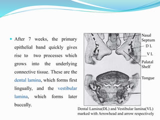  After 7 weeks, the primary
epithelial band quickly gives
rise to two processes which
grows into the underlying
connective tissue. These are the
dental lamina, which forms first
lingually, and the vestibular
lamina, which forms later
buccally.
Nasal
Septum
Palatal
Shelf
Tongue
Dental Lamina(DL) and Vestibular lamina(VL)
marked with Arrowhead and arrow respectively
D L
V L
 