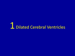 1Dilated Cerebral Ventricles
 
